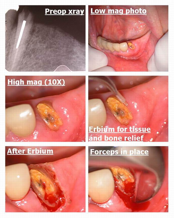 Resize of Laser assisted extraction pg 1.jpg